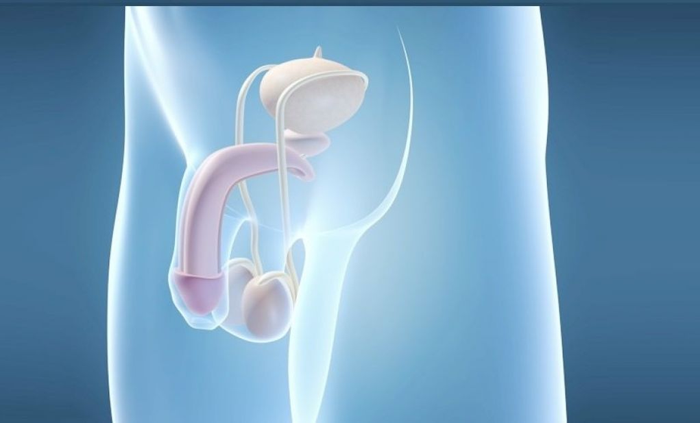 L'implantation d'une prothèse est une méthode chirurgicale permettant d'agrandir le pénis masculin. 