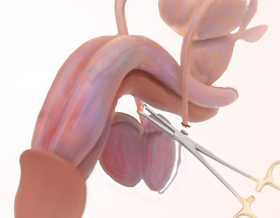 ligamentotomie pour agrandir le pénis