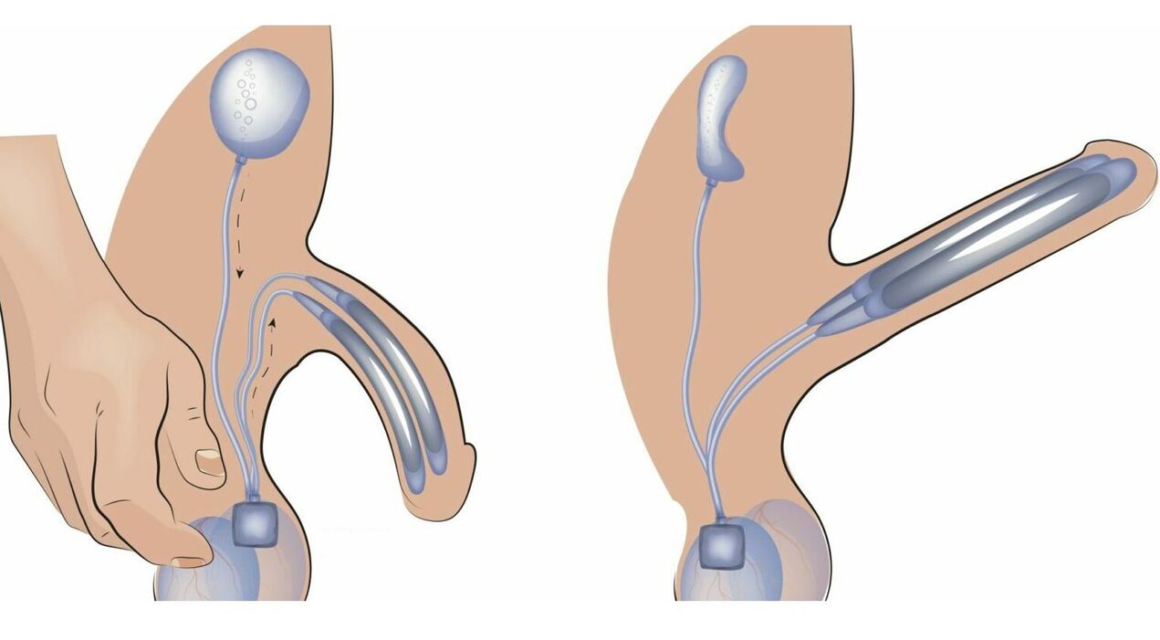 prothèse pénienne pour agrandir le pénis